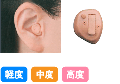 耳型タイプ1